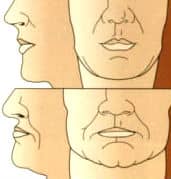 drawings showing the shrinking of the face with facial collapse