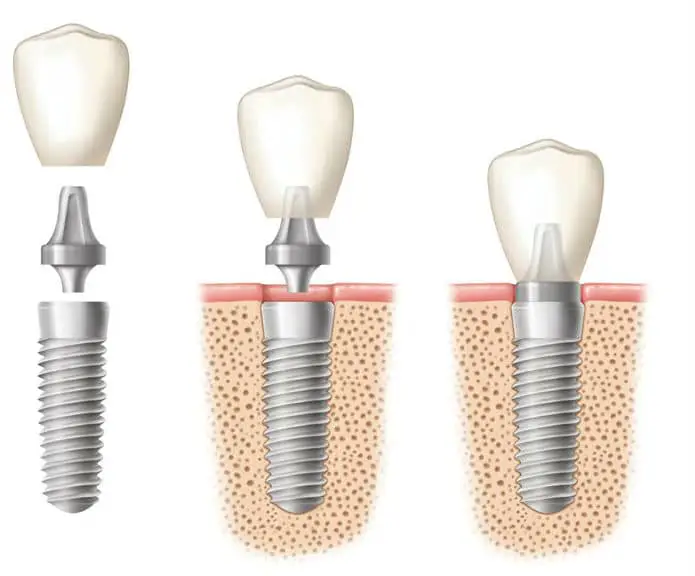 diagram-of-dental-implant-procedure