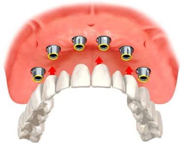 drawing-of-implant-supported-dentures