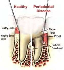 gum-disease-diagram