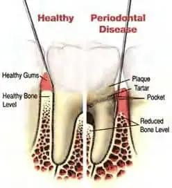 diagram-of-periodontal-disease