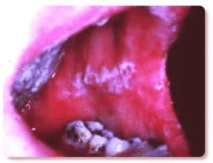photo-of-thrush-or-oral-yeast-infection