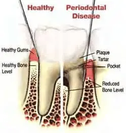 diagram-of-periodontal-cleaning-maintenance