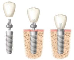 diagram of a dental implant with root form, joining piece, and crown in and out of the bone