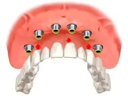 illustration of implant overdentures