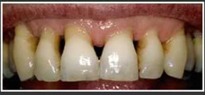 an image with gum disease