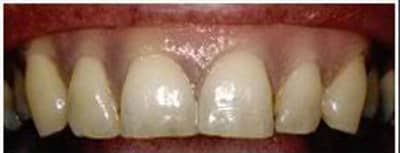 healthy gums after treatment