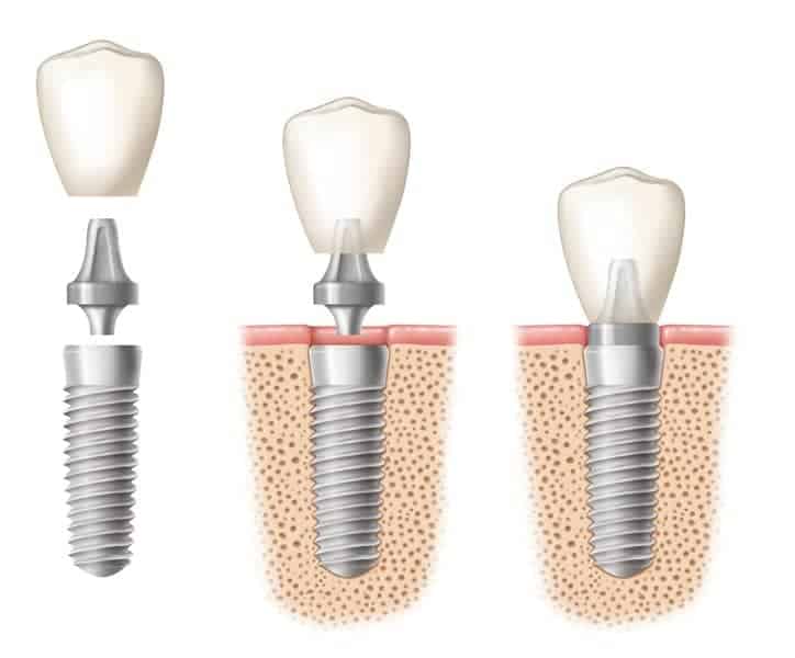 Dental implant illustration with three phases