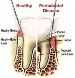 diagram of healthy gum and bone next to diseased tooth with plaque tartar periodontal pocket and reduced bone levels