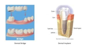 image of a dental bridge on the left and a dental implant on the right