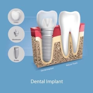 Illustration of a dental implant next to a natrual tooth