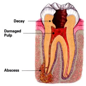 infected tooth