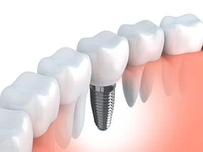 An illustration of a detnal implant between natural teeth