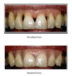Before and After Receding Gums