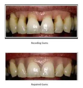 receding gums surgery before and after