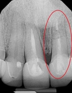 Fractured Tooth