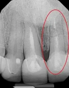 Fractured Tooth