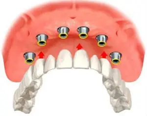 Implant overdentures