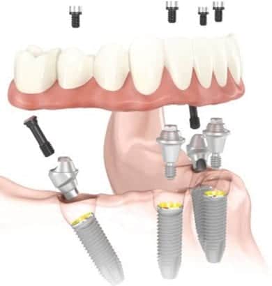 diagram of all-on-four dental implants