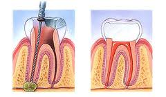 Illustration of a root canal treatment