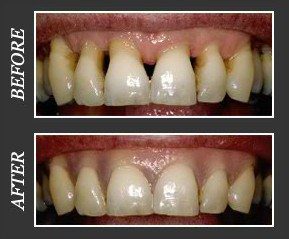 Before and after a gingival mask