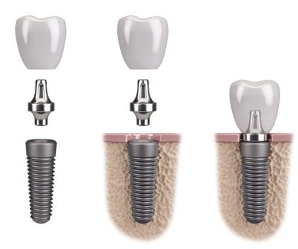 Dental implants with separated parts, then in the bone and fasted together