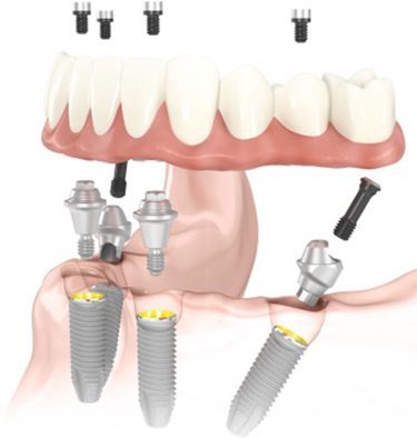 Implant dentures diagram for info on which insurance covers them