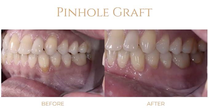 Before-and-after gum graft Pinhole Surgical Technique from Atlanta periodontist Dr. David Pumphry