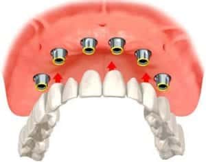 Graphic image of an upper implant-supported denture