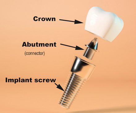 A dental implant with crown, abutment, and screw labeled, for information on titanium implant allergies