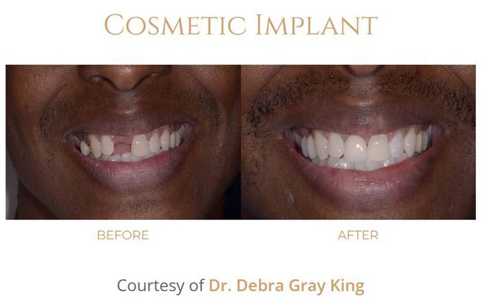 Before-and-after front-tooth dental implant photos from Atlanta periodontist Dr. Pumphrey