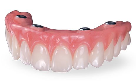 An upper implant-supported denture, available in Atlanta from Pumphrey Periodontics