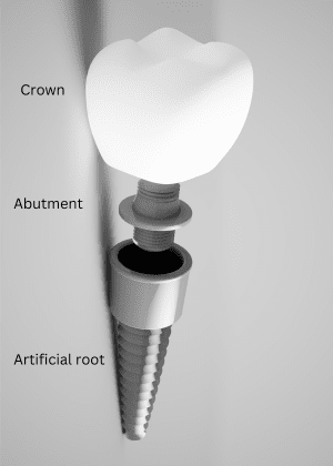 Dental implant with crown, abutment, and artificial root labeled, for information on bleeding around dental implants from Atlanta periodontist Dr. Pumphrey