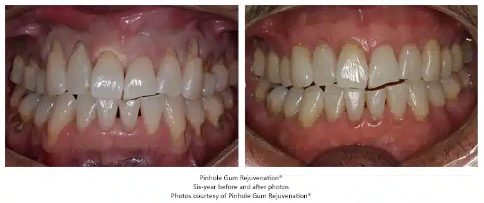 Pinhole surgical technique before and after photos, available from Atlanta periodontist Dr. Pumphrey