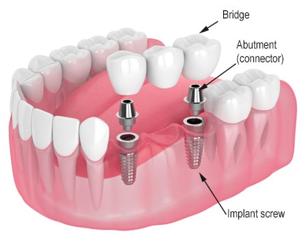 Digital model of a three-tooth dental implant bridge