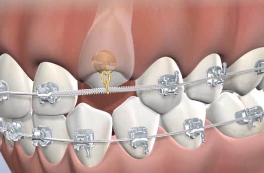 Impacted upper canine tooth with a chain attachment to a bracket to help reposition it